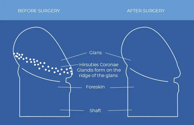 Pearly penile treatment removal
